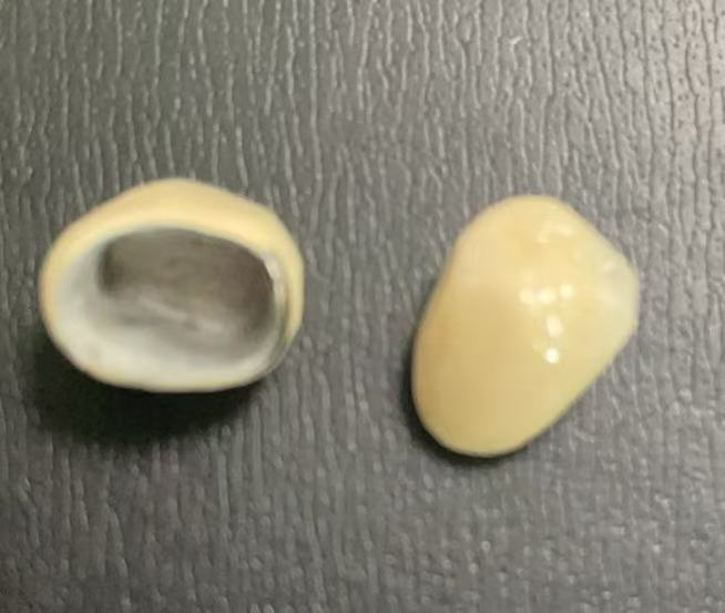 Kuinka kauan PFM -kruunu kestää? Putoako se sijoittelun jälkeen?