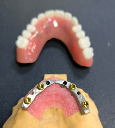 Locator ja Titanium Dental Bar