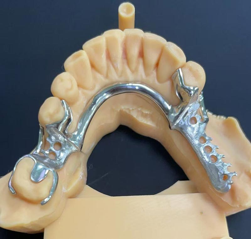 Cobolt-Chromium Frameworkin (Co Cr Framework) edut