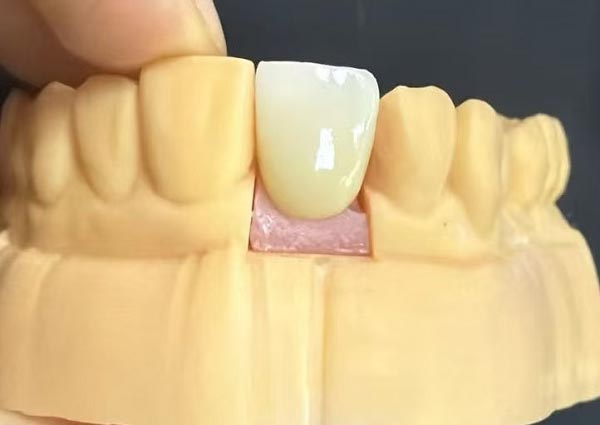 Hampaiden väliset raot voidaan korjata – suorat hampaat ovat houkuttelevimpia!