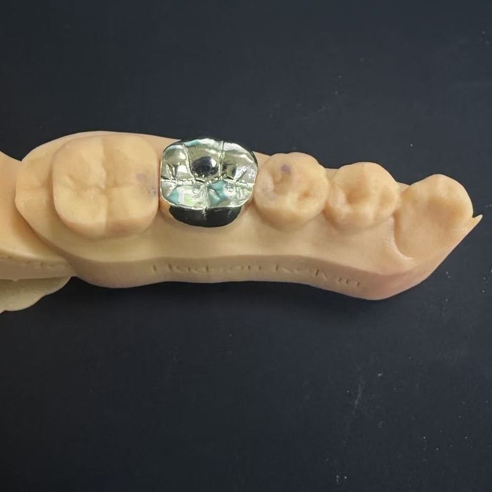 Kultakruunut: jalometallivalinta elinikäiseen hampaiden restaurointiin