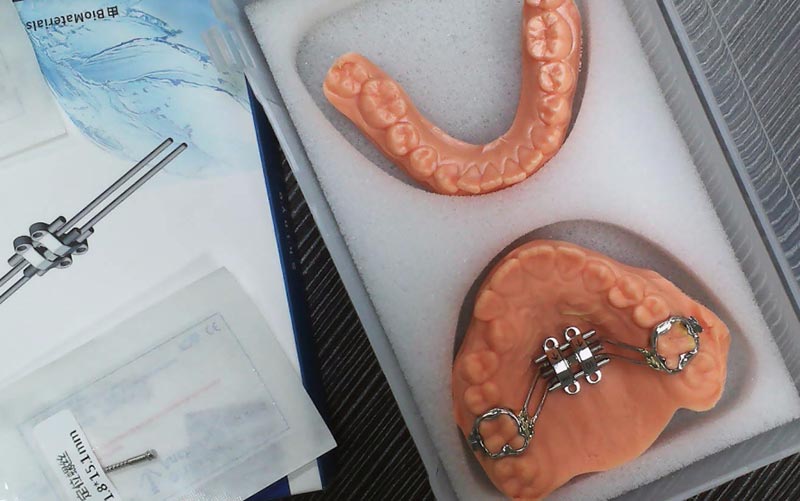 Ymmärrä MSE:n luuston laajentaminen WM Dental Labin avulla