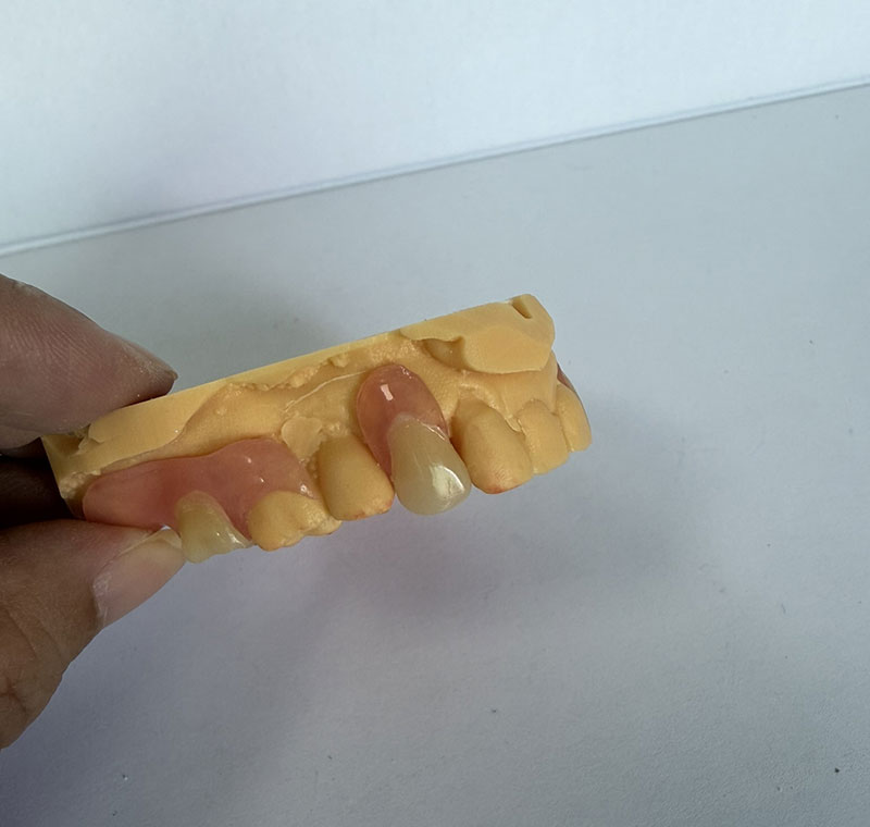 Valplast Partials WM Dental Labissa