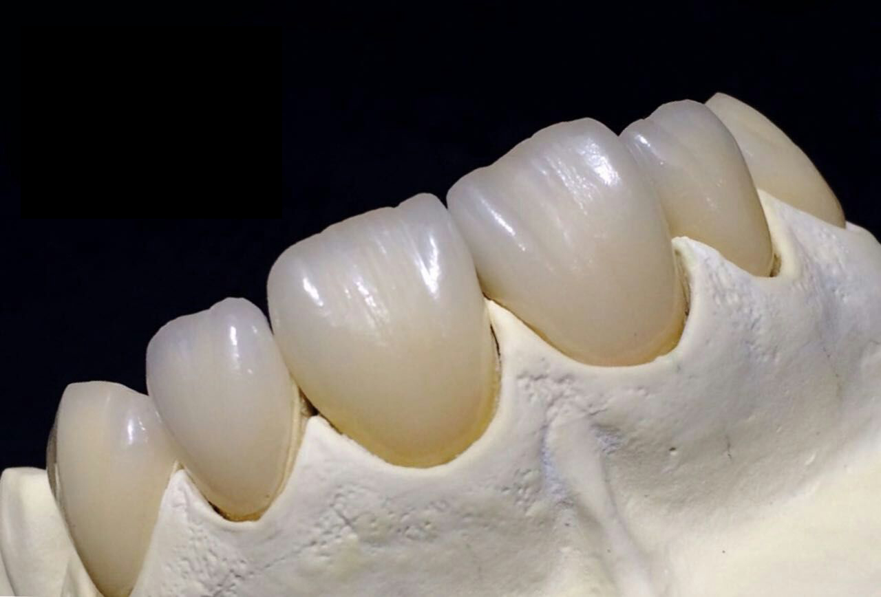 Full Zirkonia Crown Kiinan hammaslaboratorio