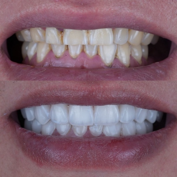 Emax Layered Veneers Esthetic China Dental Lab työ